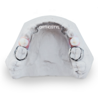 Arc lingual avec dents prothétiques